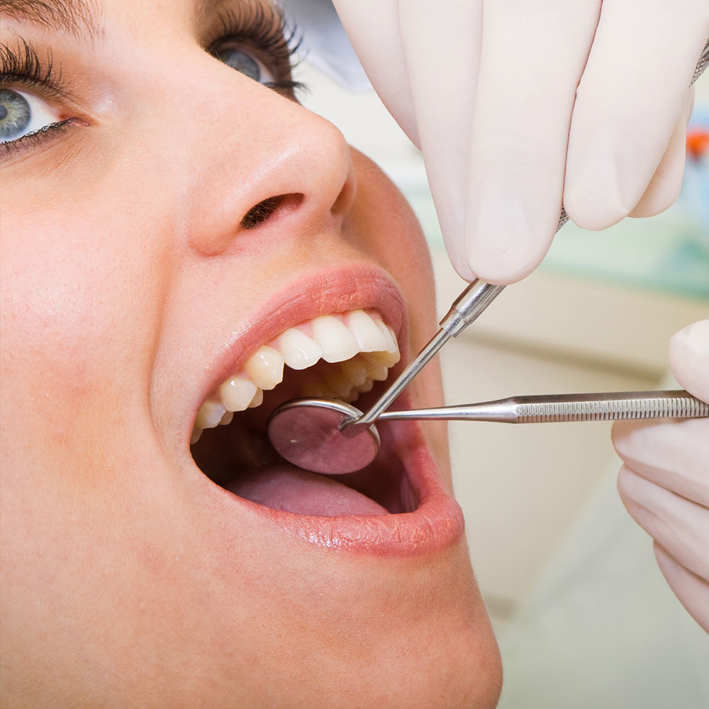 Chipped tooth repair exam in Downey